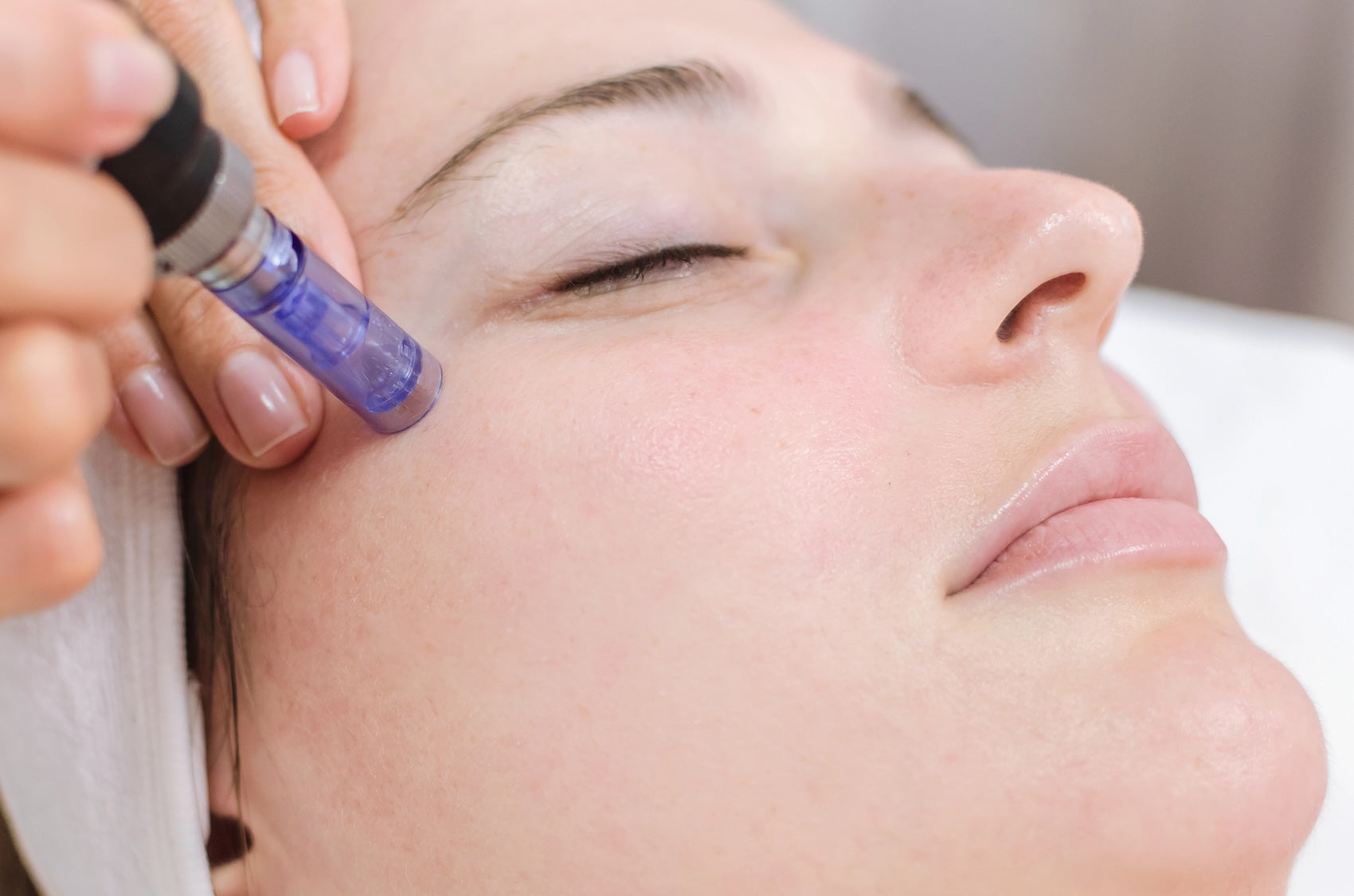 Microneedling Treatment